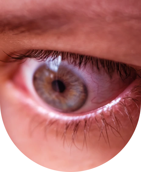 Inflammatory-eyeimage