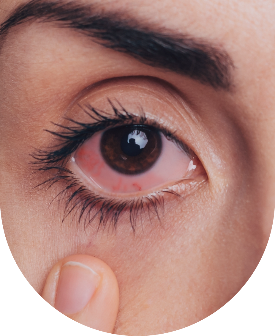 cornea_oc_eye