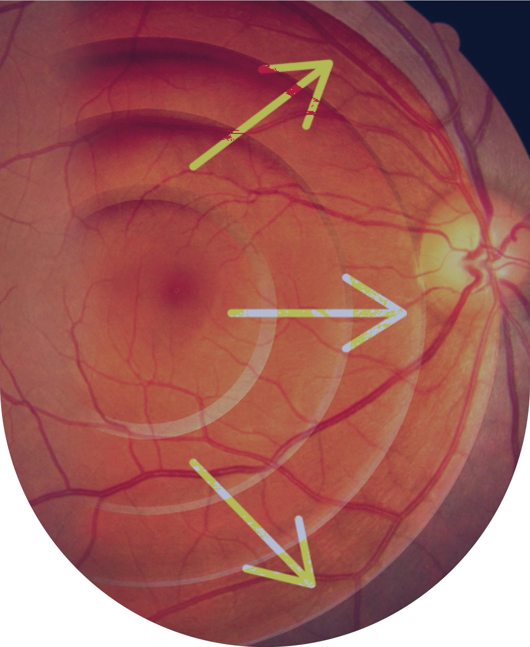 optic_neuropathies2