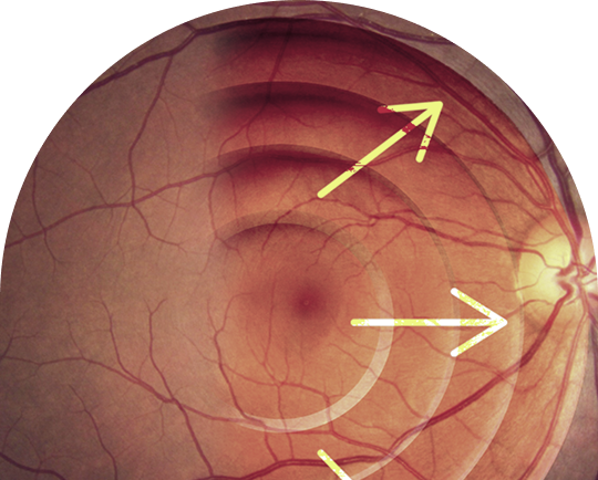Glaucoma_mobile