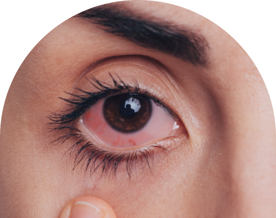 Ocular_surface_mobile